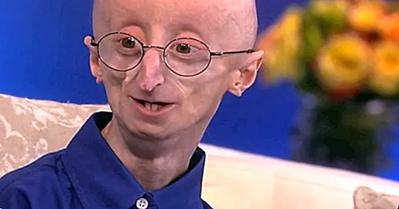 Progeria: sebab, gejala dan rawatan
