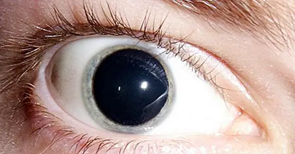Mydriasis (extreme dilation of the pupil): symptoms, causes and treatment