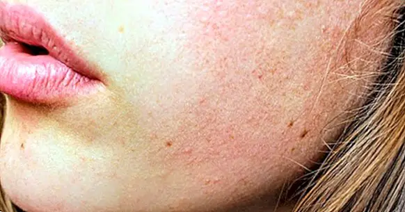 Comment enlever les cicatrices d'acné: 8 conseils