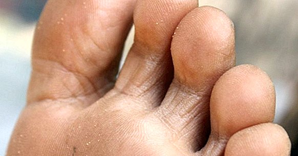 Svampe i fødderne: årsager, symptomer og behandling