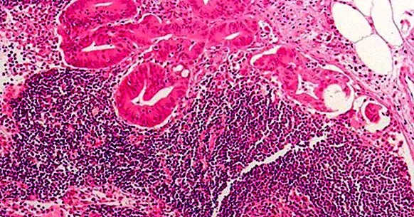 Rakovina hrubého čreva: 8 varovných príznakov