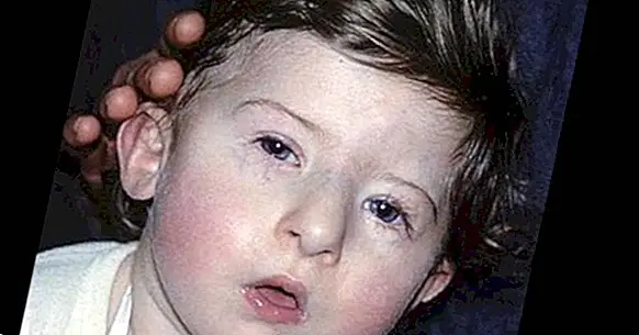 DiGeorge syndrome: symptoms, causes and treatment