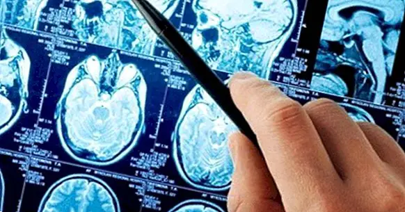 Cerebral aneurisme: årsager, symptomer og prognose