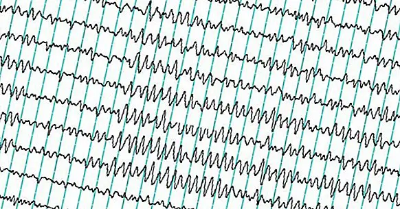 تخطيط كهربية الدماغ (EEG): ما هو وكيف يتم استخدامه؟