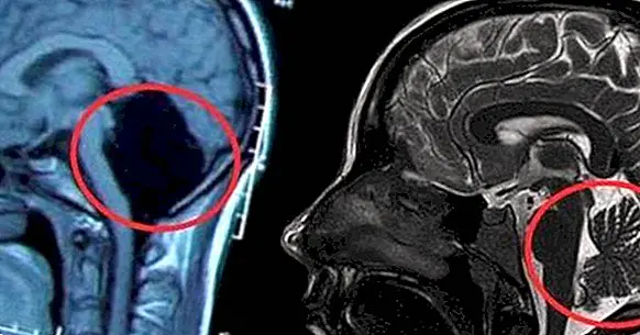 The unusual case of a woman without cerebellum that has surprised the scientific community