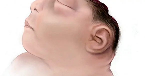 Anencephaly: causes, symptoms and prevention