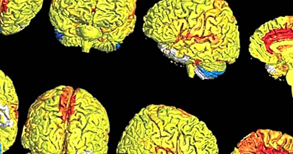 Den kvindelige hjerne er mere aktiv end den menneskelige hjerne, ifølge en undersøgelse