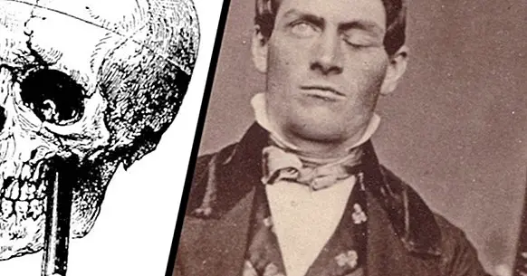 The curious case of Phineas Gage and the metal bar in his head