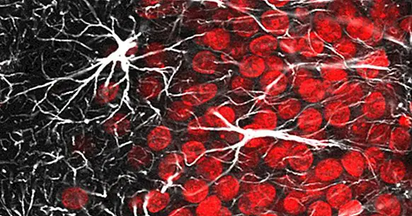 Glias rolle i nevrologisk sykdom