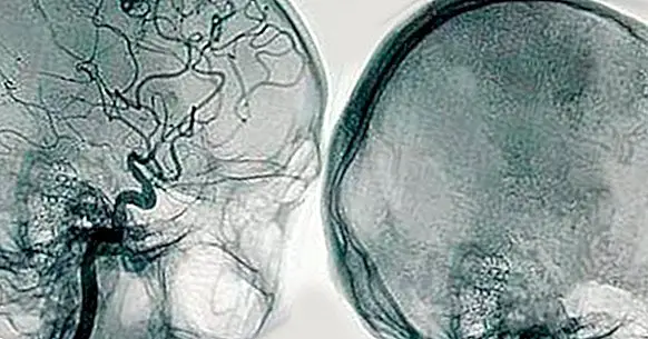 脳血管造影：それは何であり、どのような障害が検出できるでしょうか？