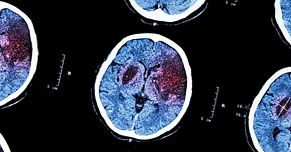 Εγκεφαλικό: ορισμός, αιτίες, συμπτώματα και θεραπεία