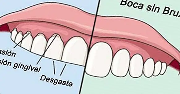Bruxismus (mletí zubů): příčiny, příznaky a léčba