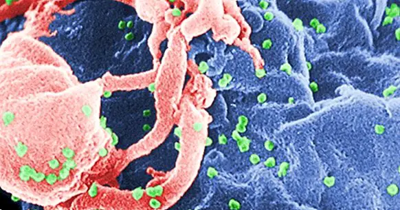 Demencja związana z HIV: objawy, stadia i leczenie