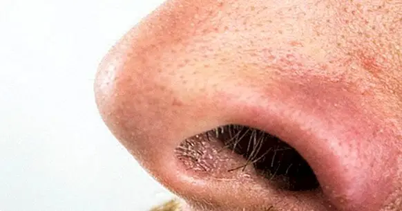 Sådan fjerner du hudorme fra næsen: 7 tricks og retsmidler