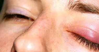 How to cure a stye in 7 simple steps - Medicine and health