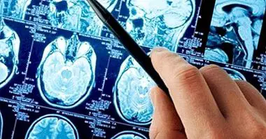 Anevrism cerebral: cauze, simptome și prognostic - medicina și sănătatea