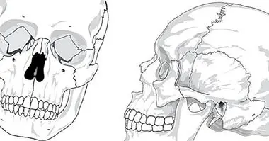 עצמות הראש (גולגולת): כמה יש שם ואיך הם נקראים? - מדעי המוח