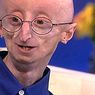 meditsiin ja tervis: Progeria: põhjused, sümptomid ja ravi