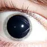 medicina e saúde: Midríase (dilatação extrema da pupila): sintomas, causas e tratamento
