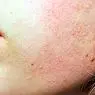 médecine et santé: Comment enlever les cicatrices d'acné: 8 conseils