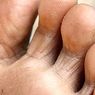 thuốc và sức khỏe: Nấm ở bàn chân: nguyên nhân, triệu chứng và cách điều trị