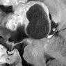 Brain tumor: typy, klasifikace a příznaky - medicíny a zdraví