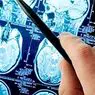 την ιατρική και την υγεία: Εγκεφαλικό ανεύρυσμα: αιτίες, συμπτώματα και πρόγνωση