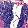 medicina e saúde: Os 2 tipos de mielite: sintomas, causas e tratamento