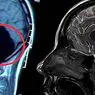 Необичайният случай на жена без мозък, който изненада научната общност - невронауки