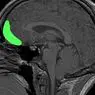 Orbitofrontaalne ajukoor: osad, funktsioonid ja omadused - neuroteadused