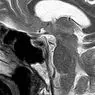 Cryptomnesia: kad jūsu smadzenes plagiyizes sevi - neirozinātnes