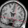 nevrovitenskap: Meynerts basale kjerne: hva det er og hva dens funksjoner er