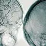 клинична психология: Церебрална ангиография: какво е това и какви разстройства може да открие?