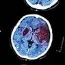 脳卒中：定義、原因、症状および治療 - 臨床心理学