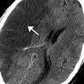 Psicologia clinica: Isquemia cerebral: sintomas, causas e tratamento