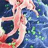 Demens forbundet med hiv: symptomer, stadier og behandling - klinisk psykologi