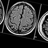 ניוון קליפת המוח: תסמינים, גורמים והפרעות נלוות - פסיכולוגיה קלינית